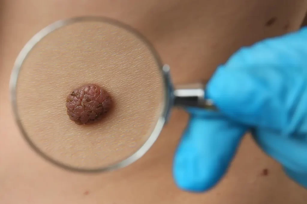 Cirugía lunares cáncer Quito Dr Carlos Riofrio Cirujano Oncologo