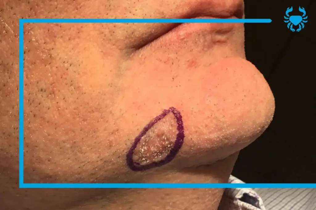 Cirugía Melanoma Piel Quito Dr Carlos Riofrio Cirujano Oncologo