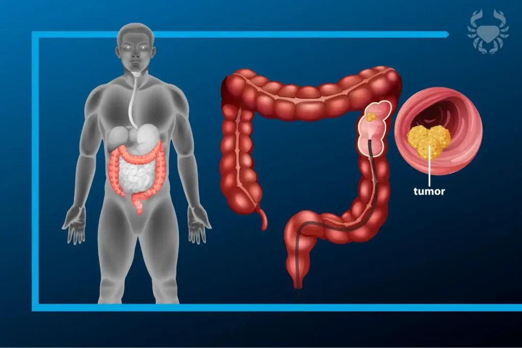 Cirugía Cáncer Colon Quito Dr Carlos Riofrio Cirujano Oncologo